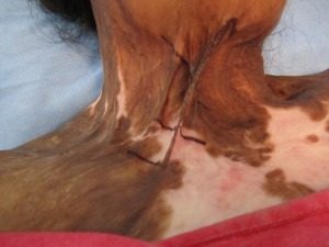 burn_scar_z-plasty_neck_release_2