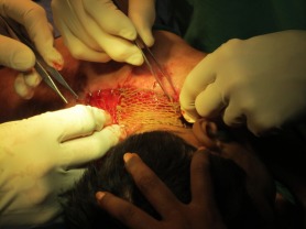 skin_graft_boy_sutured